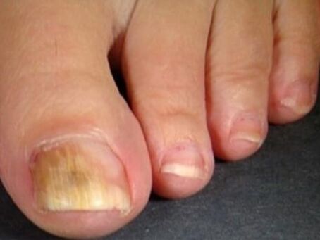 Nail filgus