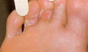 Dermaid Lesions fir Fouss mycosis