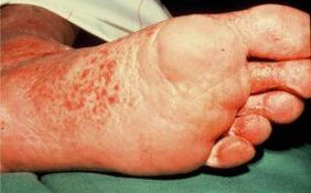 Pilz um Fouss mat Ulcer