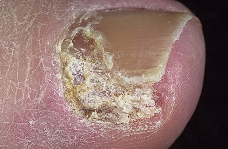 Aarte vun Onychoycosis